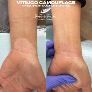 Beginner Scar Camouflage, Inkless Scar & Stretch Mark Revision - DEPOSIT