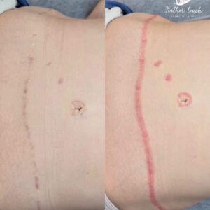 Advanced Scar Camouflage & Inkless Scar and Stretchmark Revision - DEPOSIT