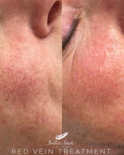 Skin Treatment - Skin Rejuvenation