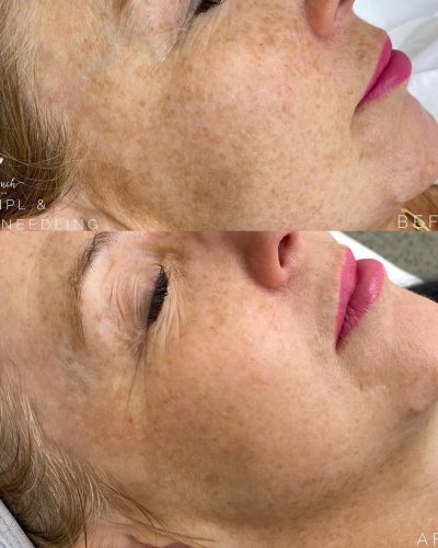 Skin treatment - Dermal needling 1